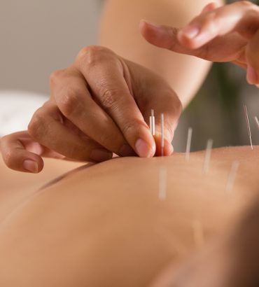 Czym różni się suche igłowanie od akupunktury?